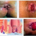 Obat Wasir Faktu thumbnail