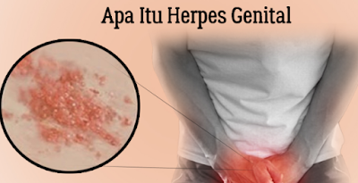 Foto obat herpes genital yang ampuh manjur