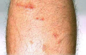 So Cool: Poison Ivy - Poison Oak
