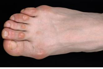 How do you treat bone spurs in the feet?