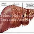 Pengobatan Tradisional Pengerasan Hati