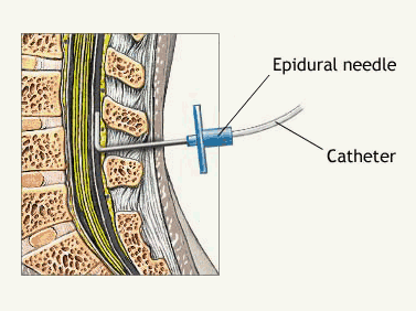 Epidural steroid injection during labor