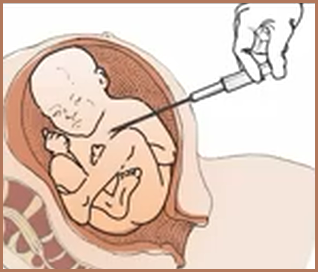 Lethal injection method of ensuring fetal demise during abortion