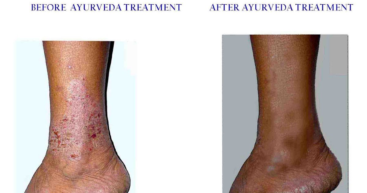 AYURVEDA ECZEMA PHOTO before and after My Ayurveda treatment