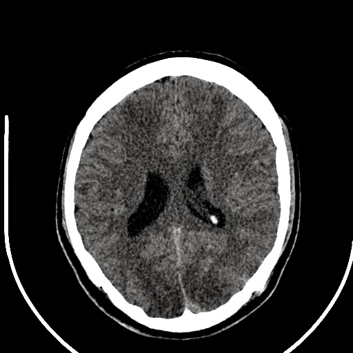 Ultimate Radiology Bilateral thalamic and cerebellar hypodensity