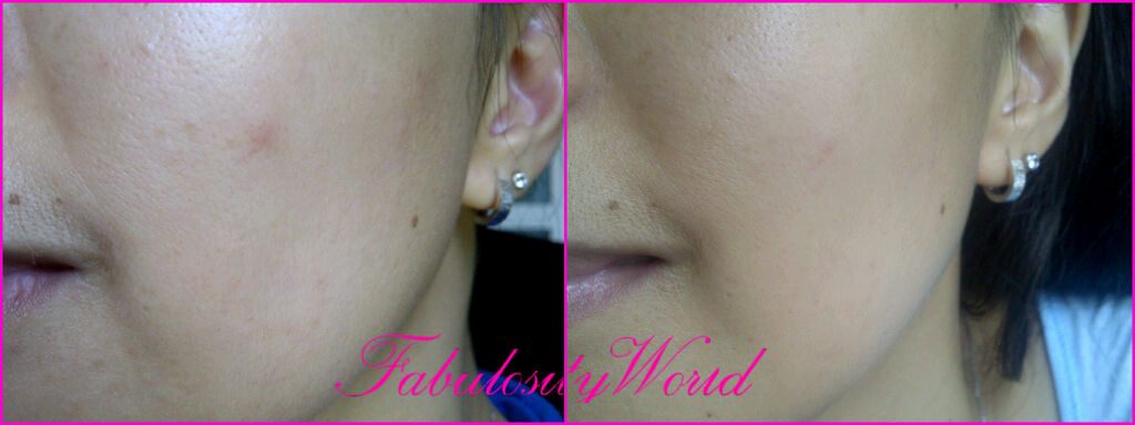 Accutane To Help Blackheads