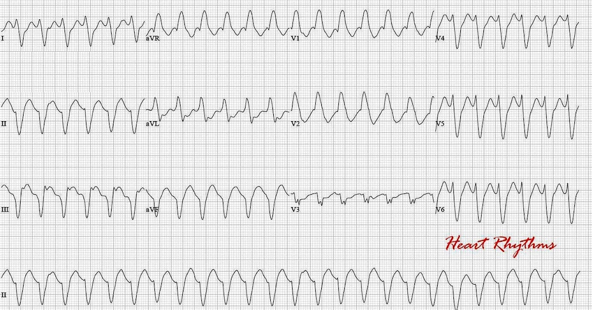 Transition Of Wide Qrs Tachycardia With Left Bundle B vrogue.co
