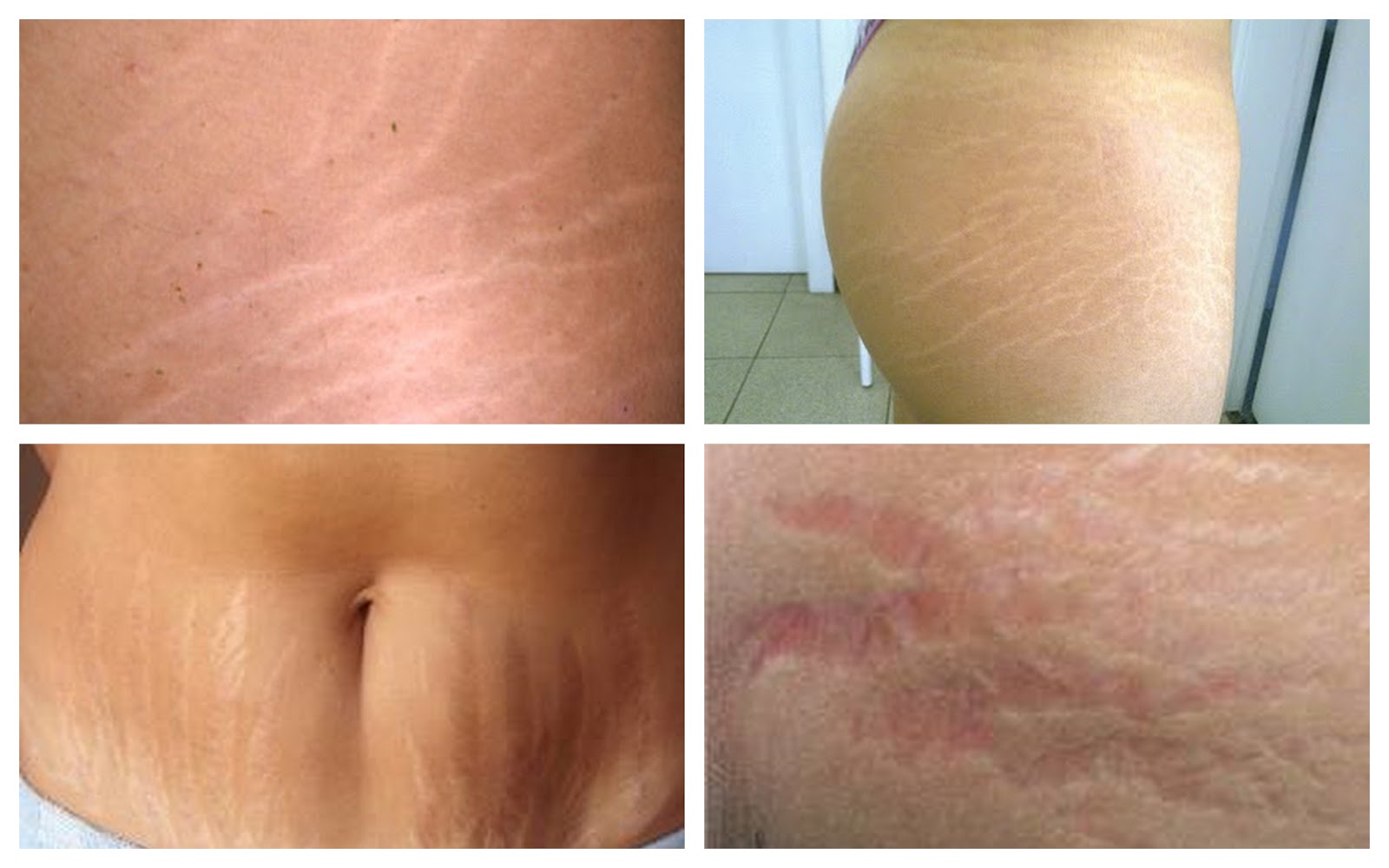 Amiga da Pele: Estrias: prevenir ou remediar?