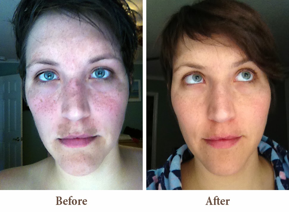 San Diego Global Laser Vision & Cosmetics Peelicious wonders Roar ;)