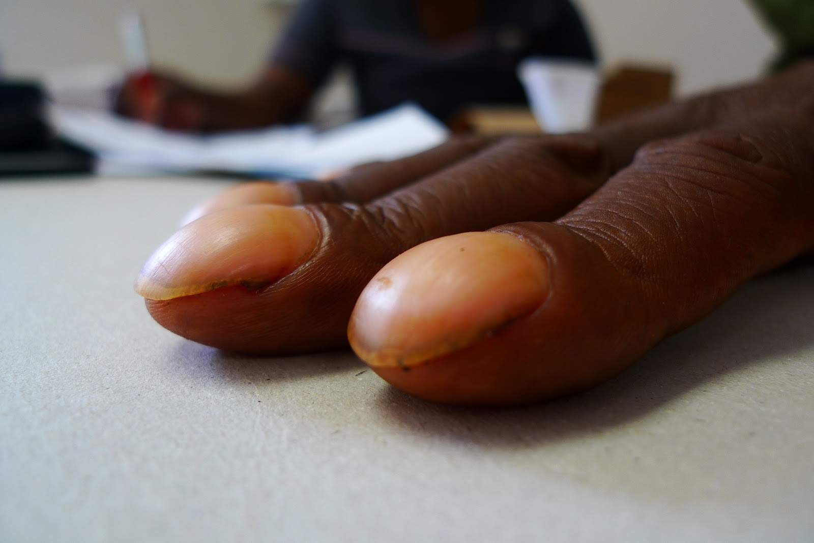 Does Nail Clubbing Look Like*^