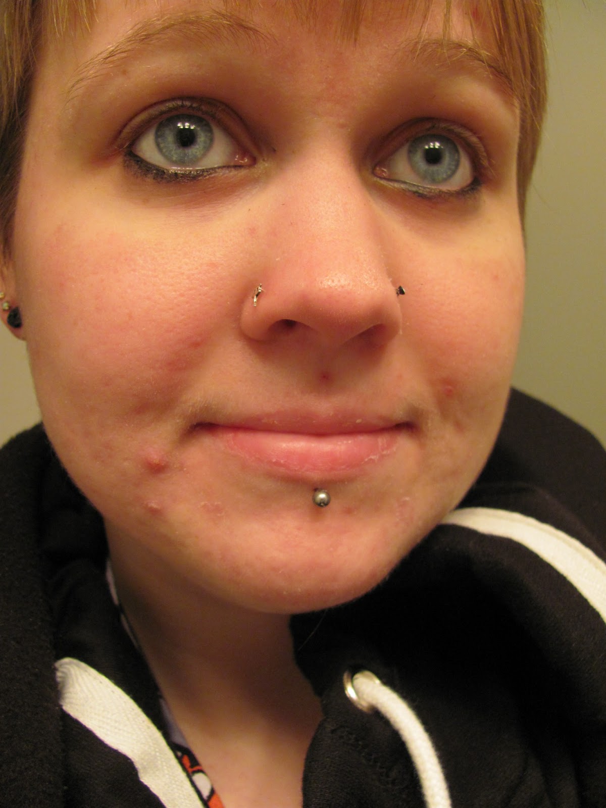 Writings And Rants Month 2 3 Of Accutane In Pictures