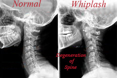 Car Accident Chiropractor Settlement Car Accident Chiropractor Settlement