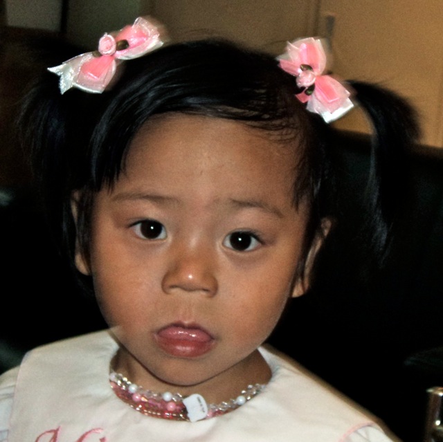 Bring my sons from afar... Before and After Tongue Reduction Surgery