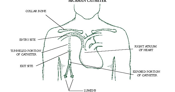 hickman triple lumen catheter hickman triple lumen catheter