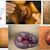 Harga Obat Wasir keluar Darah Selain Ambeven thumbnail