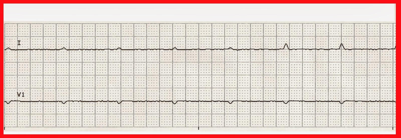 Float Nurse Practice EKG Rhythm Strips 212