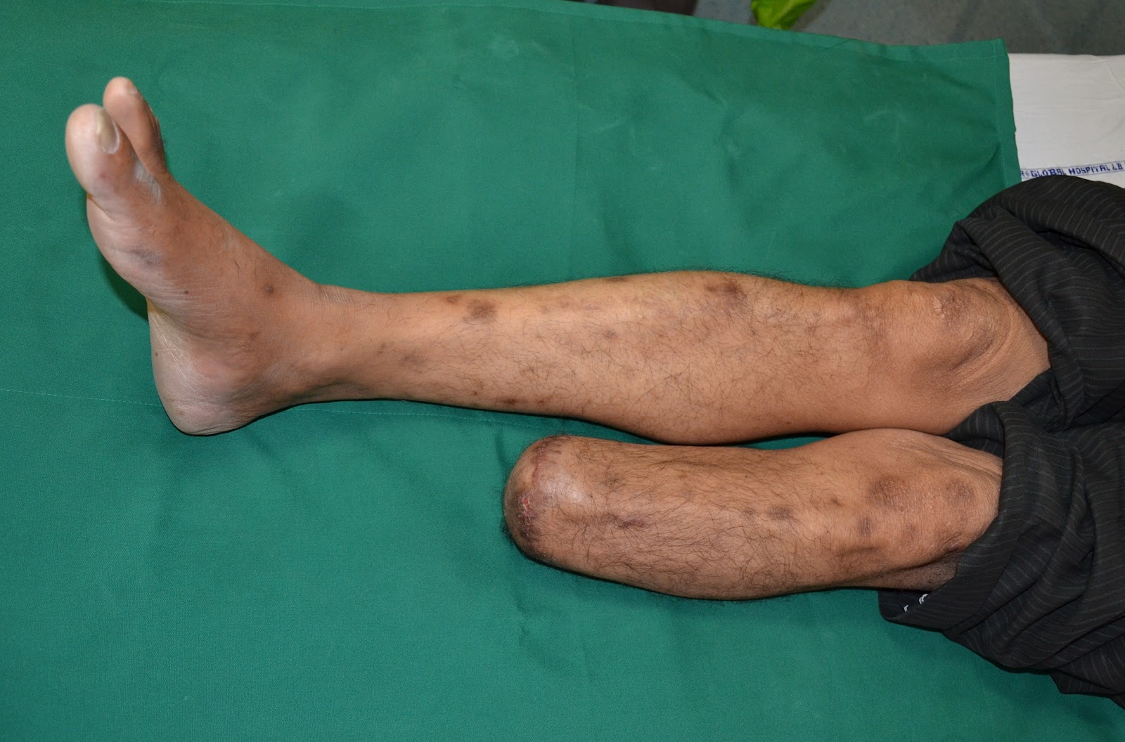 MAJOR CRUSH INJURY LEFT FOOT ASSOCIATED WITH MULTIPLE COMORBIDITIES