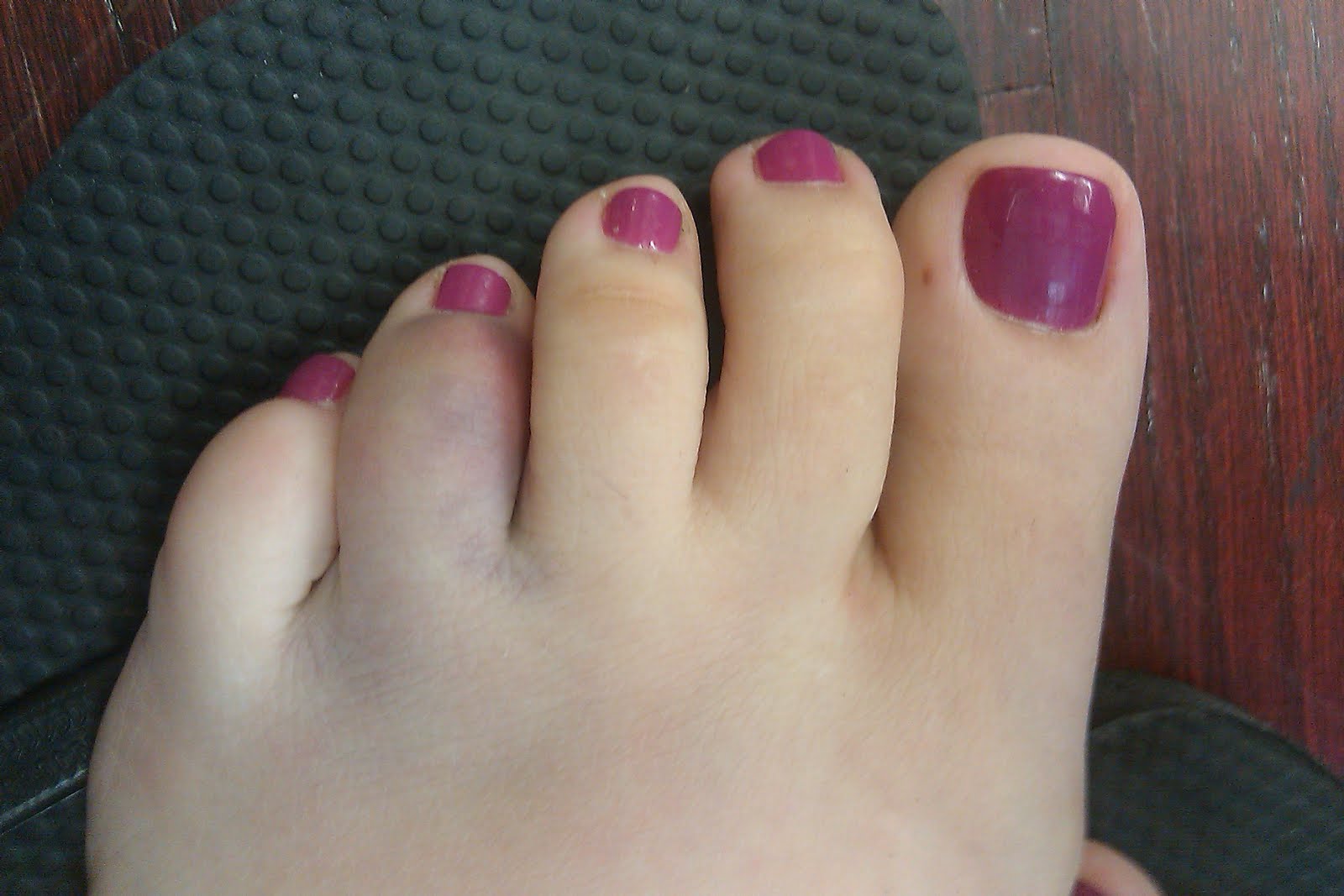 broken toe blue color under nail