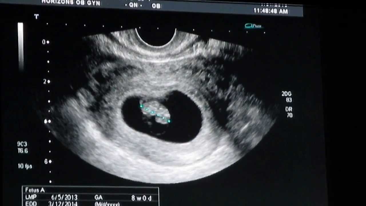 8 week ultrasound images 8 week ultrasound images