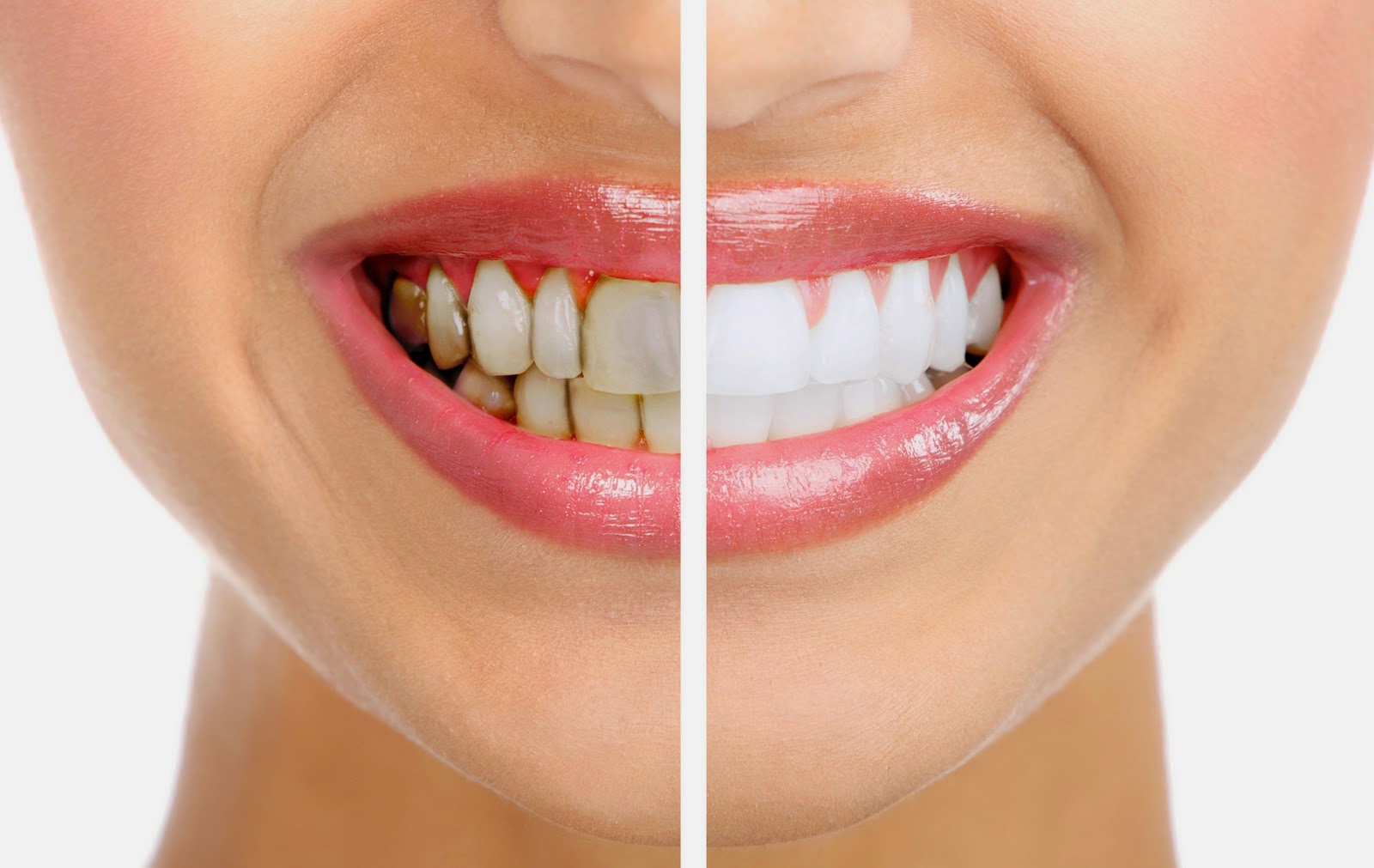 Sivilce Lekeleri Tedavisi Alüminyum Oksit Yöntemi: Mikro Peeling Nedir Sivilce Lekeleri Tedavisi Alüminyum Oksit Yöntemi: Mikro Peeling Nedir