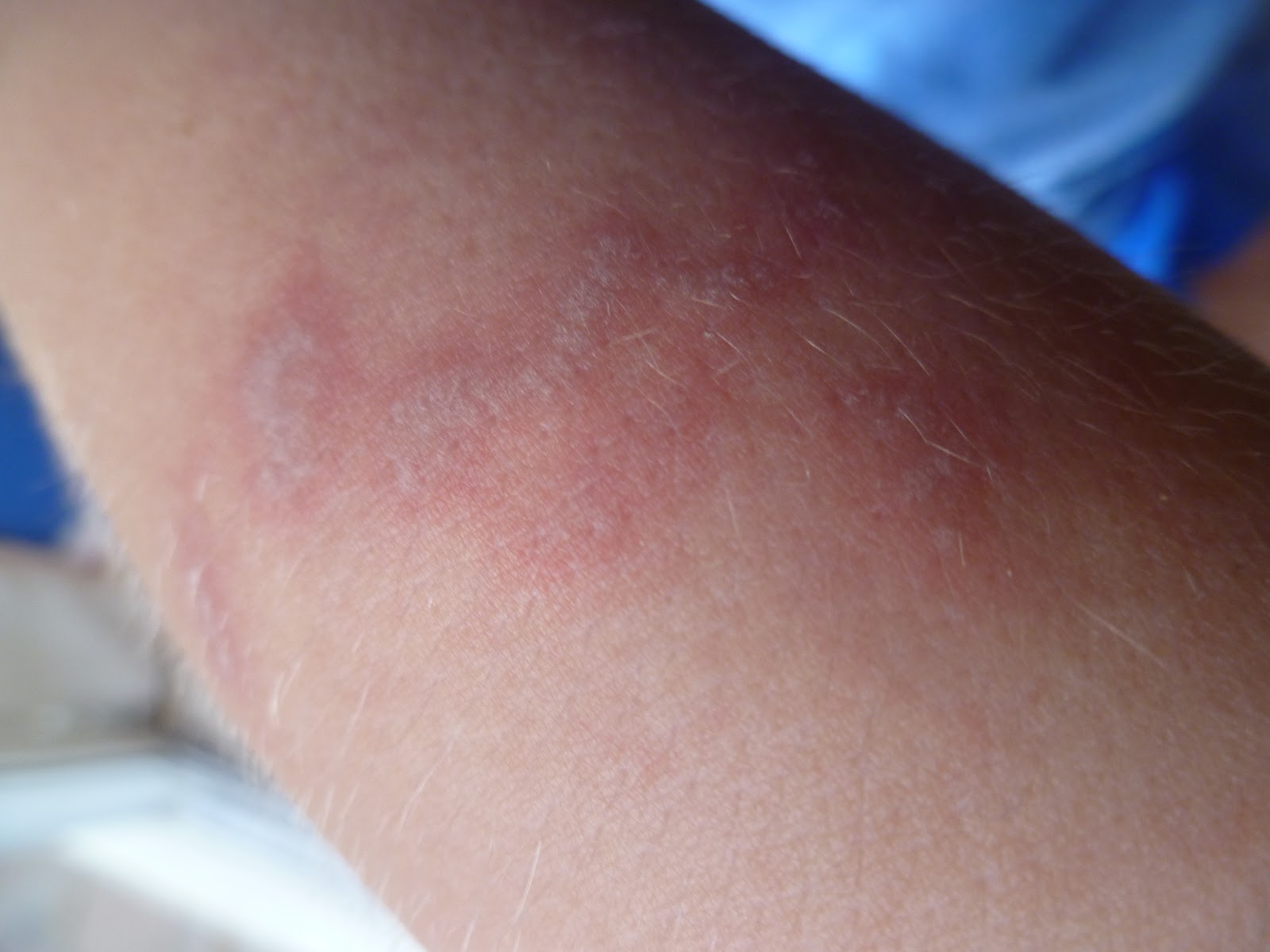 VINGEAR TO TREAT JELLY FISH WOUNDS! ANOTHER GREAT USE FOR VINEGAR