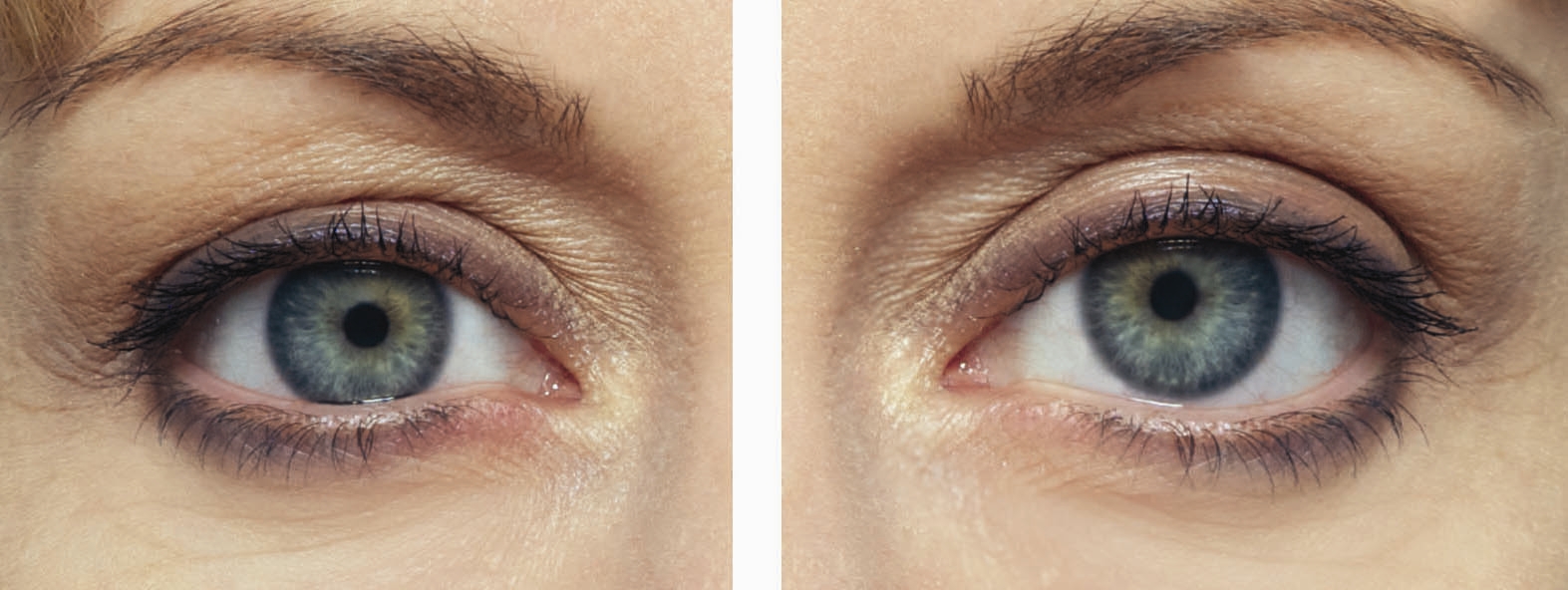 Accualaser plastic surgery associates mexico, instant eyelid eye lift