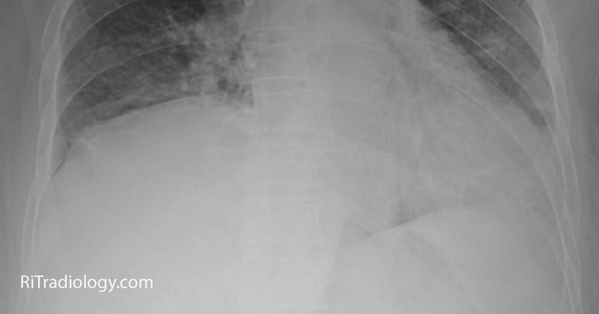 RiT radiology Unilateral Diaphragmatic Elevation