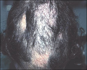 Traction alopecia steroids