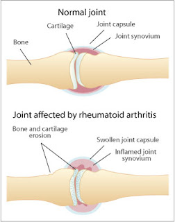 Nursing Care Plan for Rheumatoid Arthritis