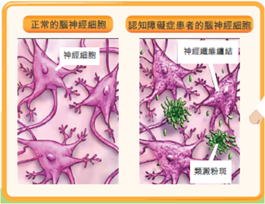 了解認知障礙症