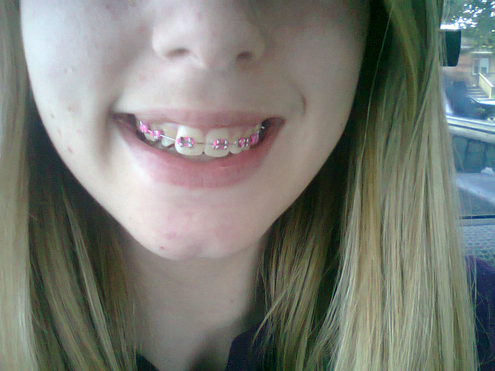 Braces! NEW COLOUR AND PALATE EXPANDER!