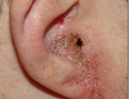 egzama tedavileri blogger