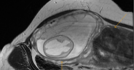 Fetal MRI with Neural Tube Defect Sumer�s Radiology Blog