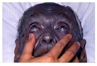 skin argyria silver blue colloidal disease causes natural medical cases generalized dynamic care herbert dijk fred hendrik memorable van still