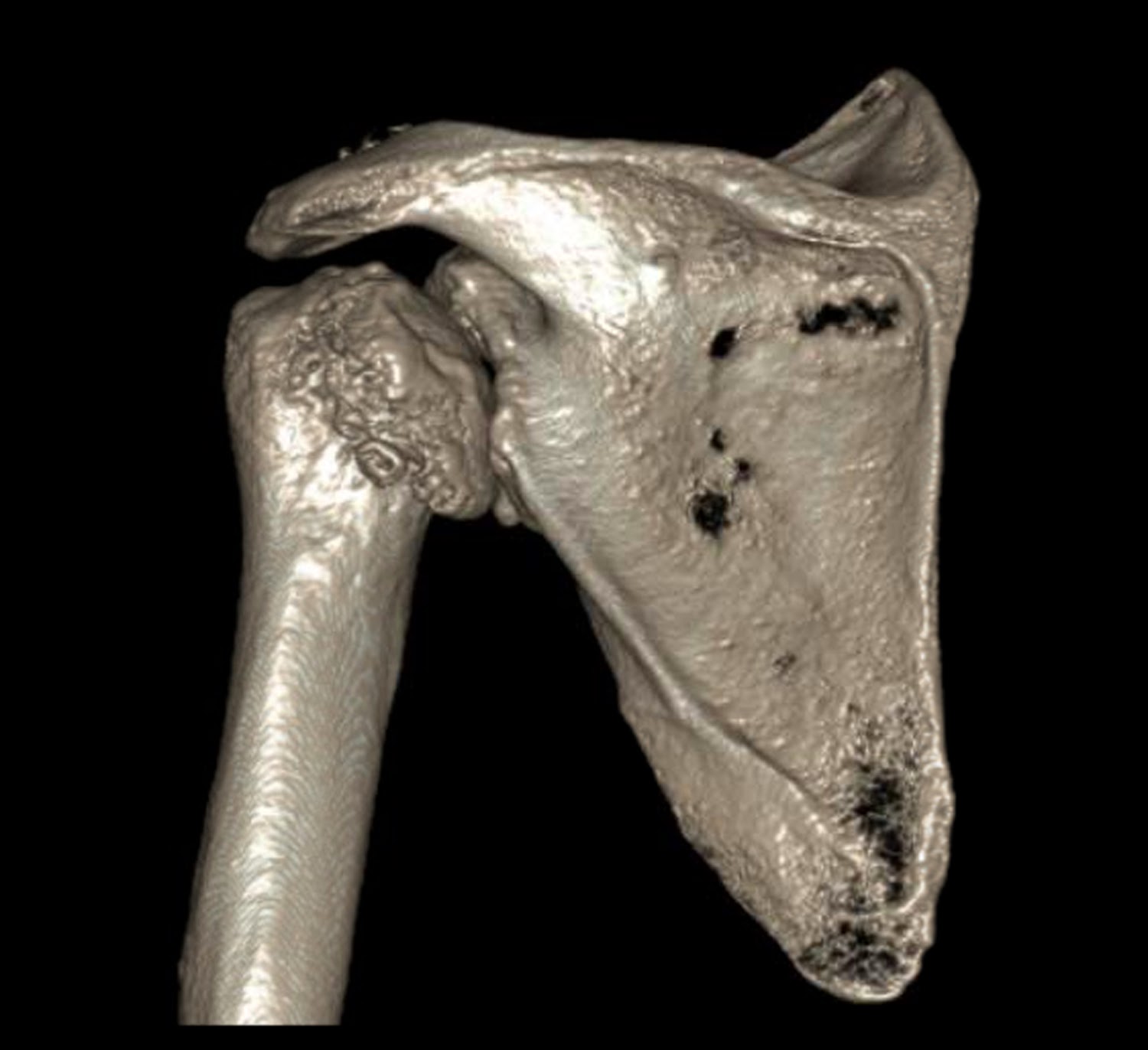 Shoulder Arthritis / Rotator Cuff Tears causes of shoulder pain
