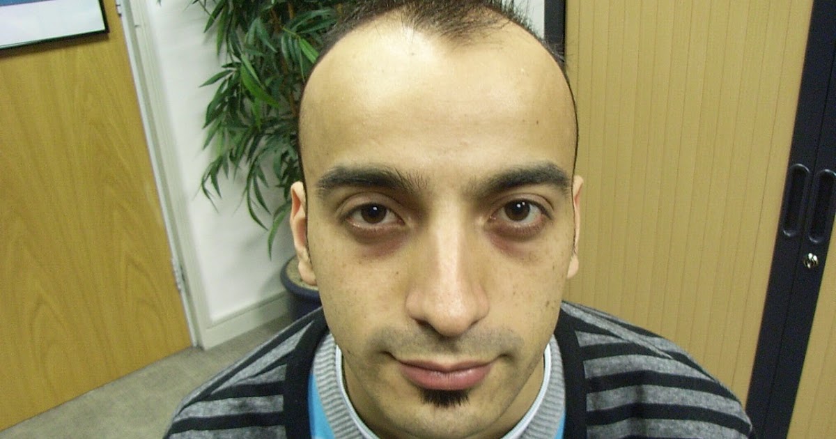 How To Solve Hair Loss In Young Men Problem The Wrong Ways To
