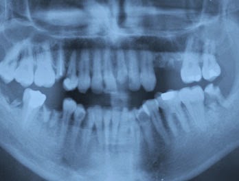 Dental Panoramic
