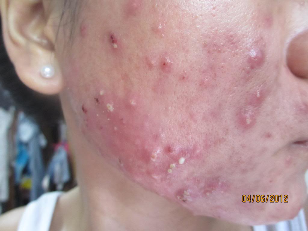 Real Asian Beauty How to get rid of ACNE