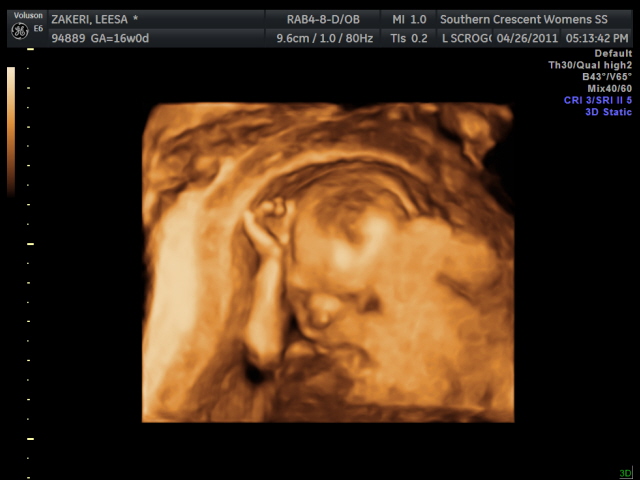 Meeshin Around 16 Week Ultrasound Reveals A Girl