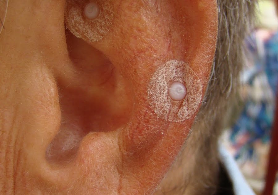 The Very Best Blog Ever!: Acupuncture! Stop smoking!