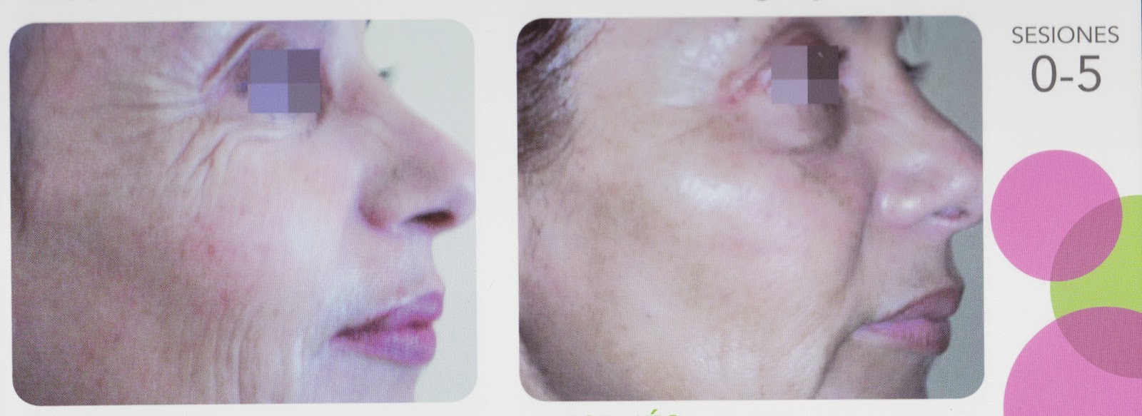 Centro de Belleza Rosi Picazo en Albacete: TRATAMIENTOS FACIALES CON INDIBA