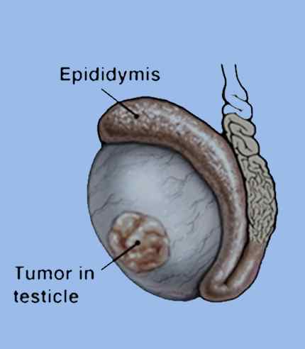 Epididymal sperm aspiration