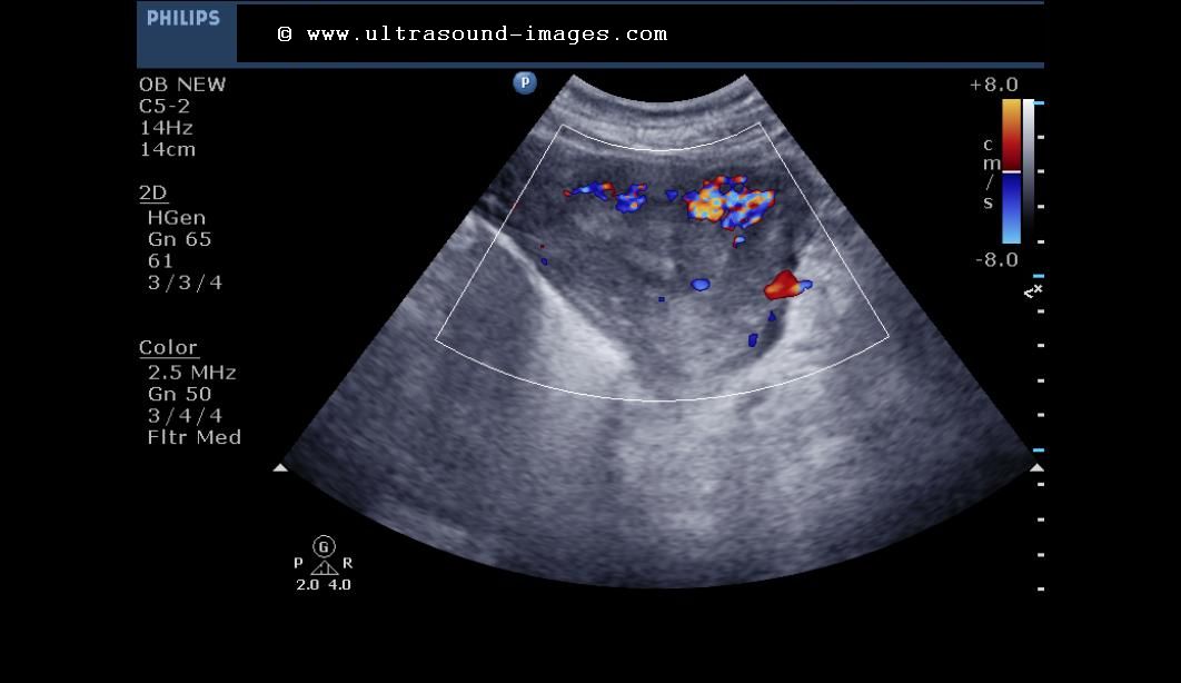 Sonography retained products of conception