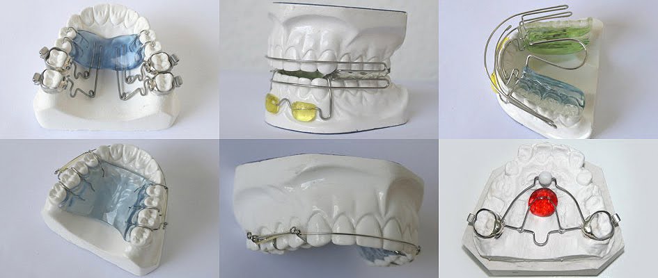 Ortodoncia aplicada a la prótesis dental