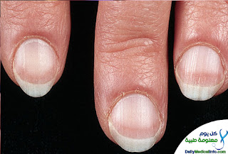 اظافرك عنوان صحتك Nails+%2811%29