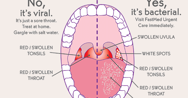 The best health ever: Natural Home Remedies for Strep Throat - Strep Throat