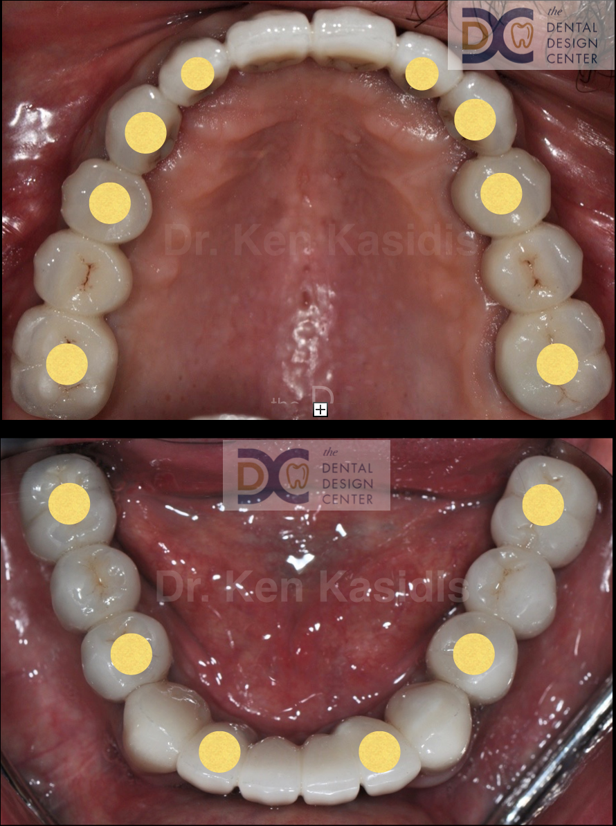 dental%2Bimplant%2Bplacement