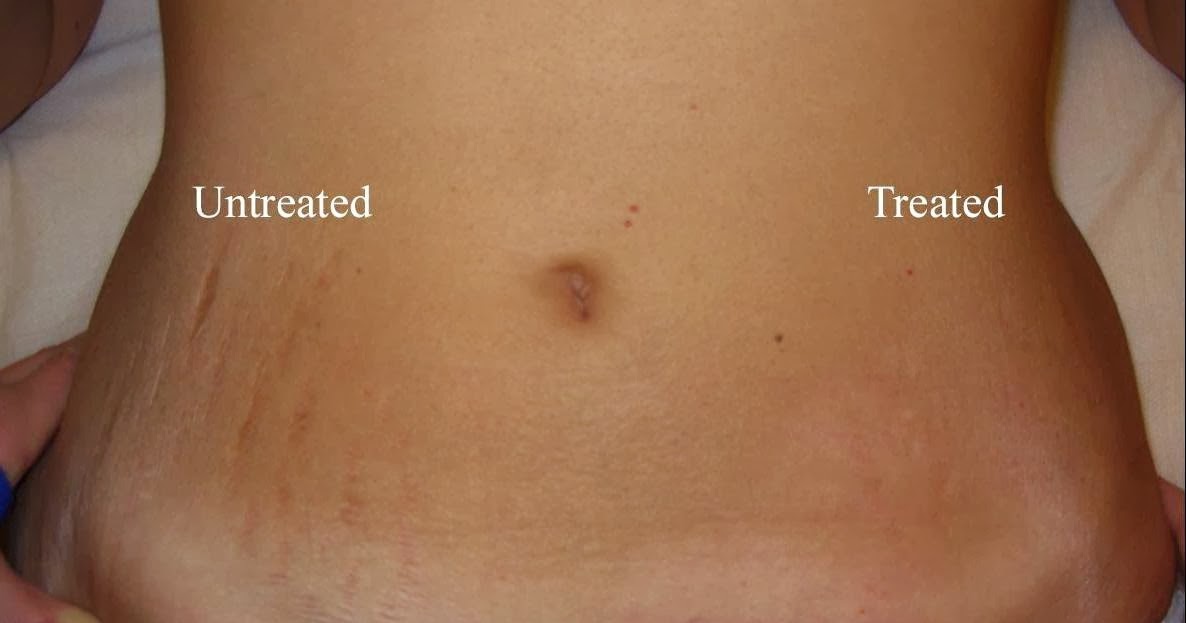 Best Natural Oil For Pregnancy Stretch Marks Best Natural Oil For Pregnancy Stretch Marks