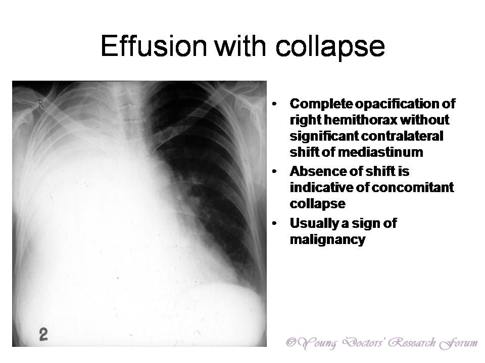 Osteomyelitis in diabetic foot: a comprehensive overview Identification of Chest X-rays of Common Lung Diseases ~ YOUNG DOCTORS