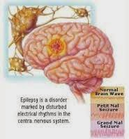 Epilepsi Epilepsi